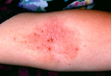 dried skin rash
